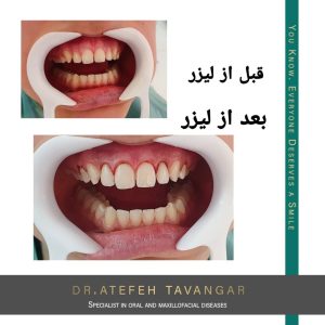 لیفت لثه با لیزر در اصفهان