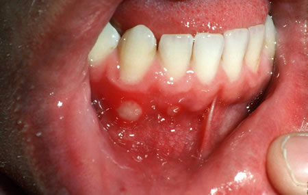 درمان آفت دهان در اصفهان با لیزر