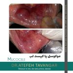 Oral-mucocele-surgery-with-laser