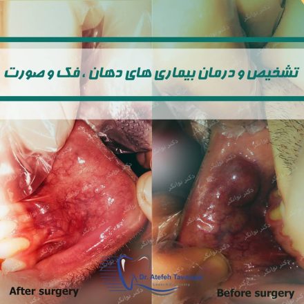 جراحی موکوسل دهانی با لیزر در اصفهان