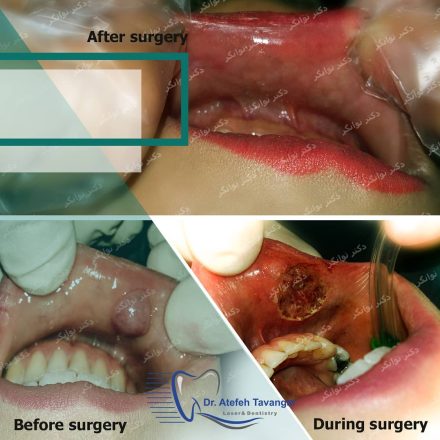 جراحی کیست دهانی با لیزر در اصفهان