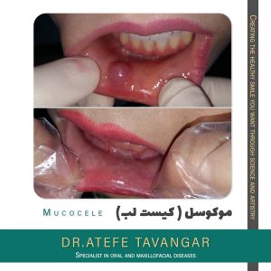 درمان کیست دهان و لب با لیزر در اصفهان