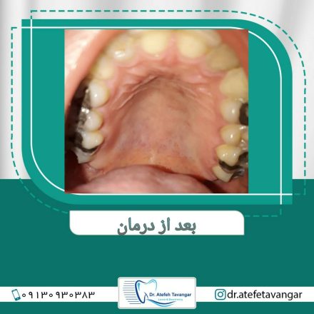 آبسه کام دهان بعد از لیزر