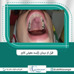 آبسه کام دهان قبل از لیزر