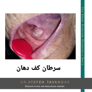 درمان سرطان کف دهان در اصفهان