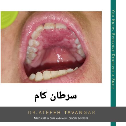 درمان سرطان کام دهان در اصفهان