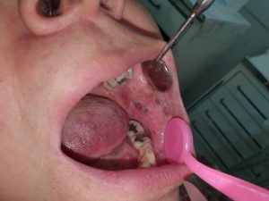 Oral-lichen-planus-09