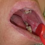 Oral-lichen-planus-10
