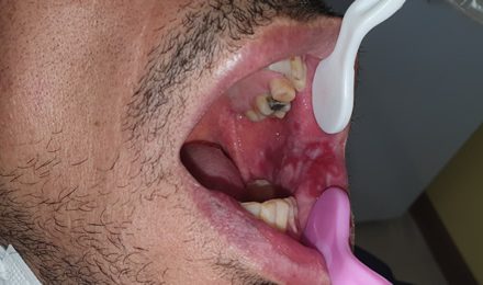 Oral-lichen-planus-14