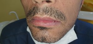 Oral-lichen-planus-18