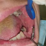 Oral-lichen-planus-20