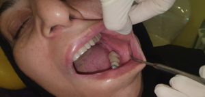 Oral-lichen-planus-27