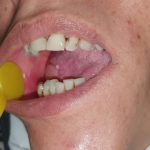 Oral-lichen-planus-29