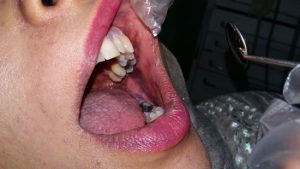 Oral-lichen-planus-30