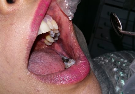 Oral-lichen-planus-30