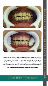 درمان سیاهی و تیرگی لثه با لیزر