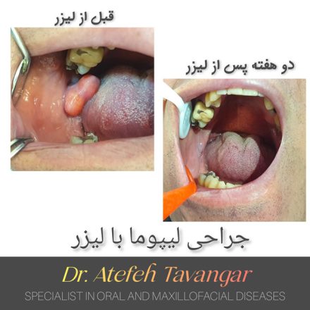 جراحی لیپوما با لیزر در اصفهان