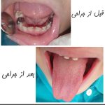 جراحی فرنکتومی لب و زبان با لیزر در اصفهان