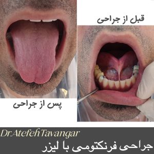 جراحی فرنکتومی لب و زبان با لیزر در اصفهان