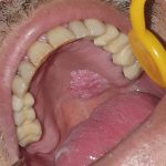 زگیل تناسلی hpv دهانی و راه های پیشگیری و درمان