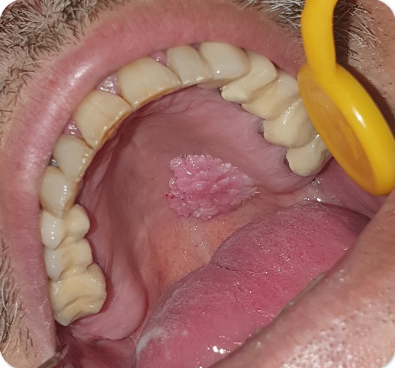 زگیل دهانی hpv و علائم و درمان