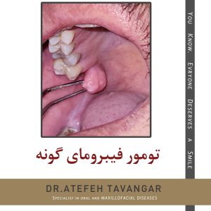 تومور فیبروم های گونه