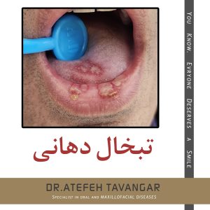 تبخال دهانی
