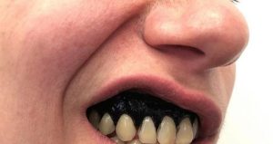 کمبود چه ویتامینی باعث سیاه شدن لثه میشود