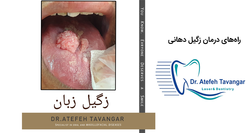 راه‌های درمان زگیل دهانی