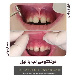 جراحی فرنکتومی بند لب با لیزر پسر 9 ساله