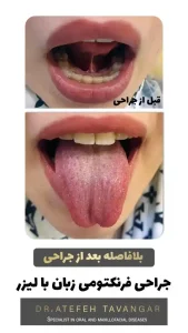 درمان فرنکتومی زبان و لب با لیزر