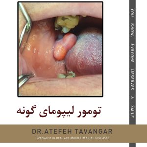 تومور لیپومای گونه