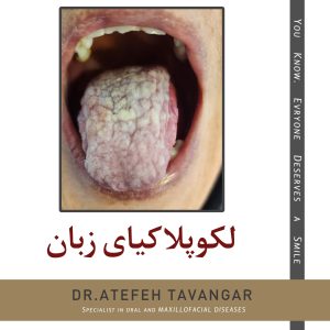 بیماری زبان لوکوپلاکیا