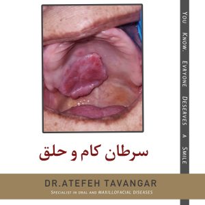 سرطان کام و حلق