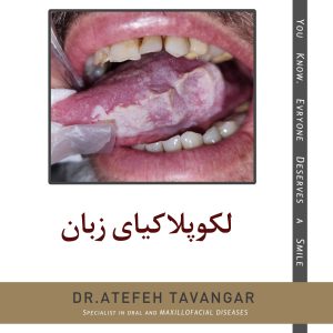 لکوپلاکیای زبان