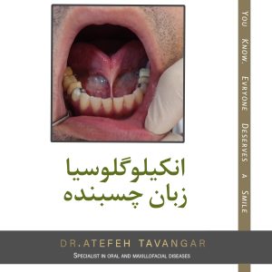 ربان چسبیده