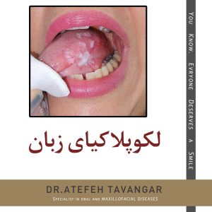 لکوپلاکیای زبان
