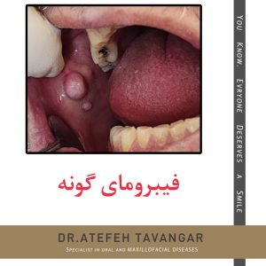 فیبرومای گونه