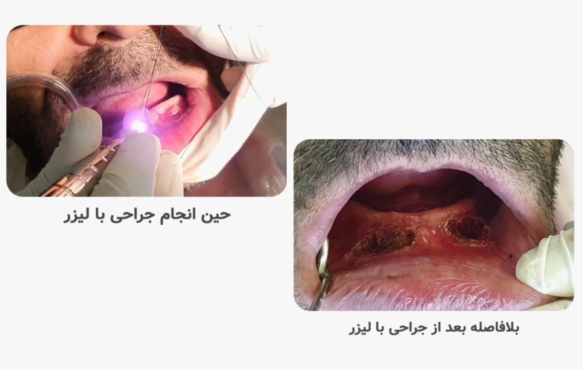 علت رشد گوشت اضافه در دهان و رابطه آن با دندان مصنوعی