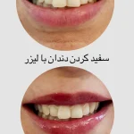 سفید کردن دندان با لیزر