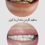 سفید کردن دندان با لیزر