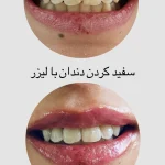 سفید کردن دندان با لیزر