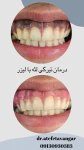 درمان تیرگی لثه با لیزر