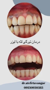 درمان تیرگی لثه با لیزر