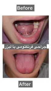 جراحی فرنکتومی زبان و لب با لیزر