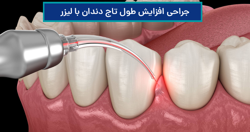 جراحی افزایش طول تاج دندان با لیزر