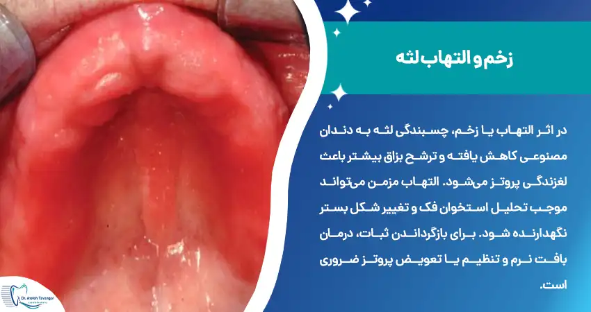 علت افتادن دندان مصنوعی به دلیل زخم یا التهاب لثه