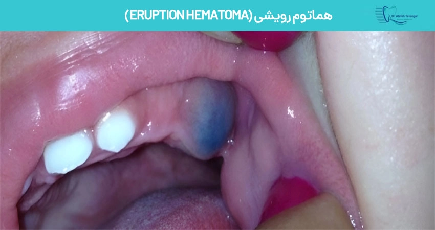 هماتوم رویشی (Eruption Hematoma)
