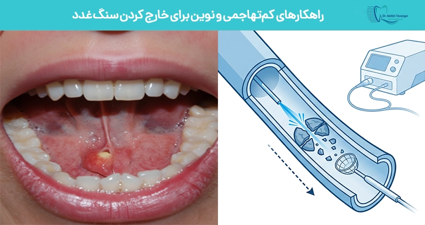 راهکارهای کمتهاجمی و نوین برای خارج کردن سنگ غدد بزاقی (لیزر و روشهای سرپایی)
