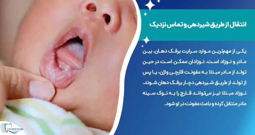 سرایت برفک دهان در مادر و نوزاد